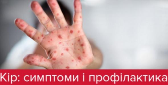 Кір в Україні: симптоми небезпечної хвороби та його профілактика